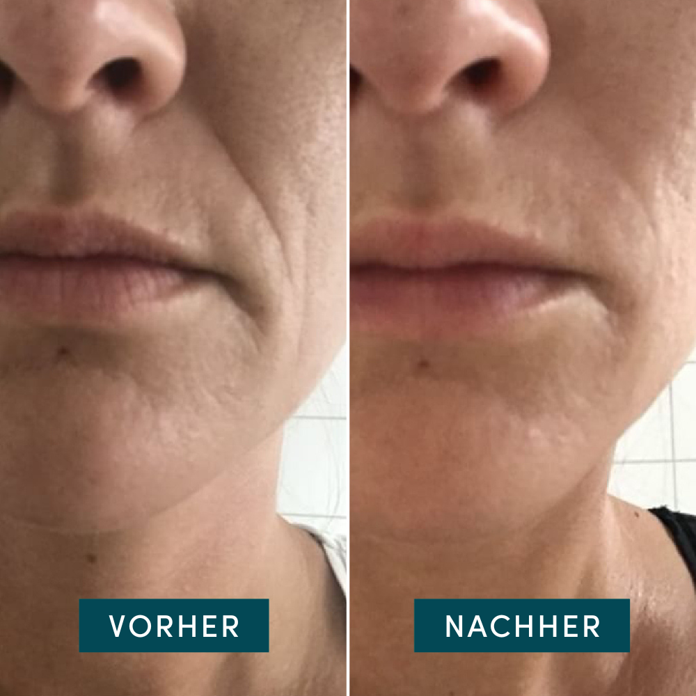 APRICOT Mouth Pads 2 Stück
