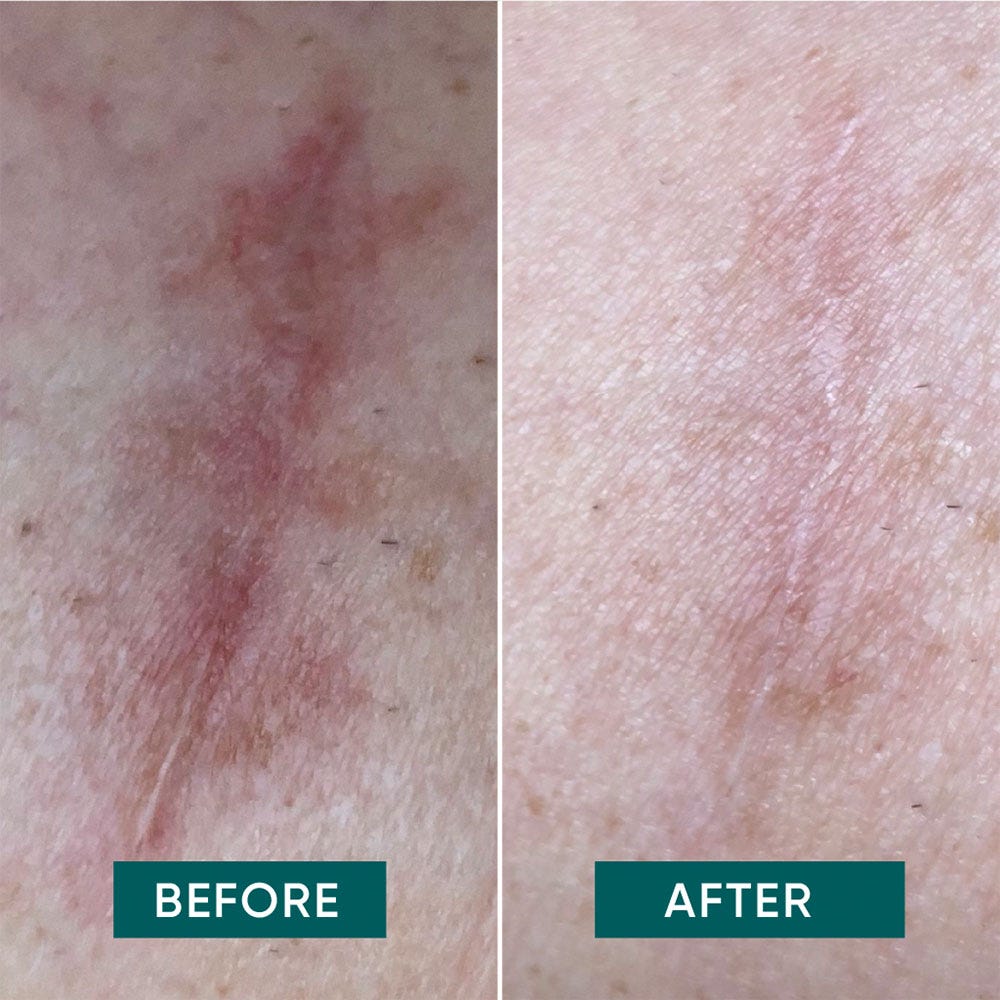 APRICOT Wiederverwendbare Narben Pads mit Aloe Vera