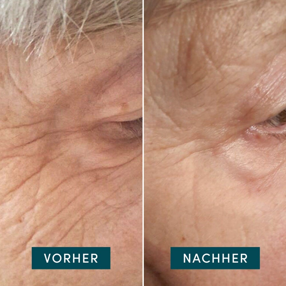 Apricot Wiederverwendbare Augen-Schläfen Pads mit Hyaluron