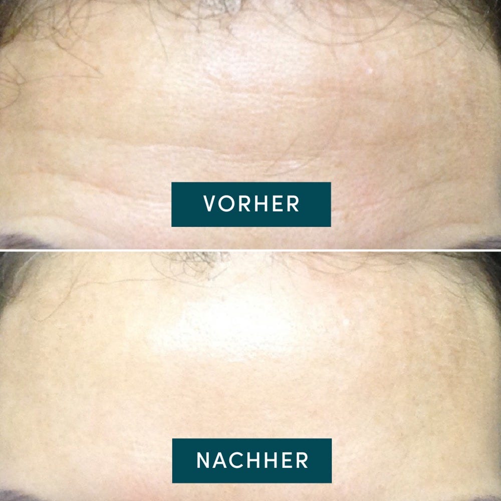APRICOT Wiederverwendbares Stirn Pad mit Hyaluron