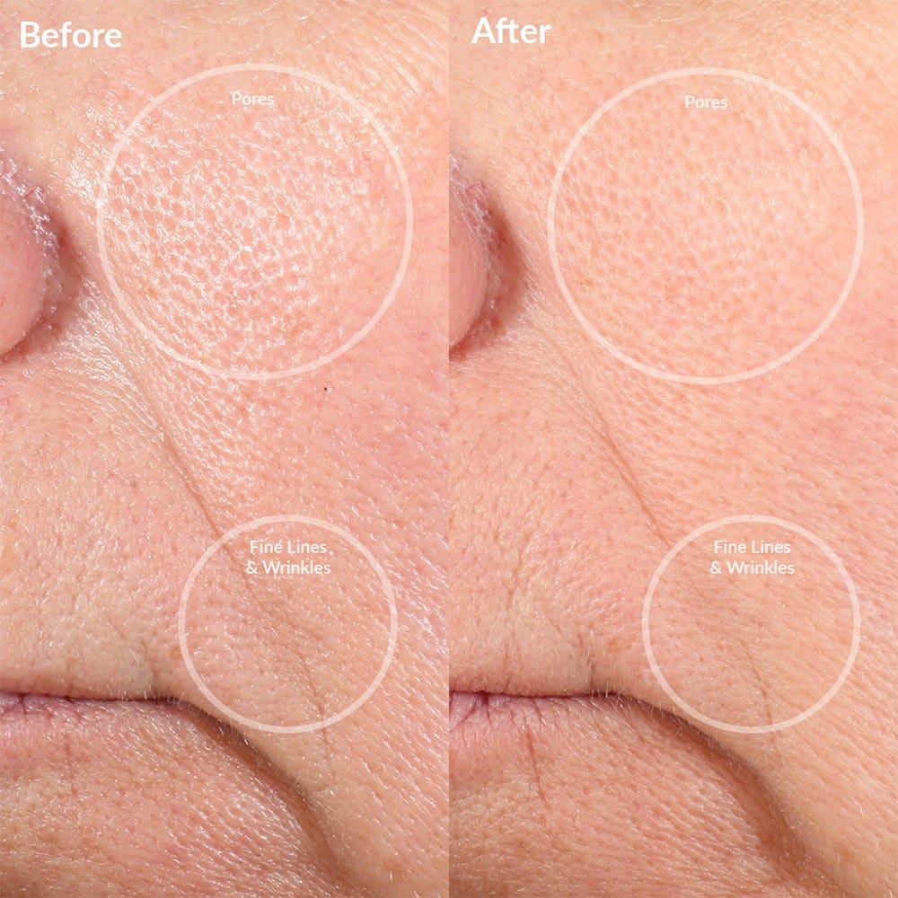 PMD Beauty Personal Microderm Pro