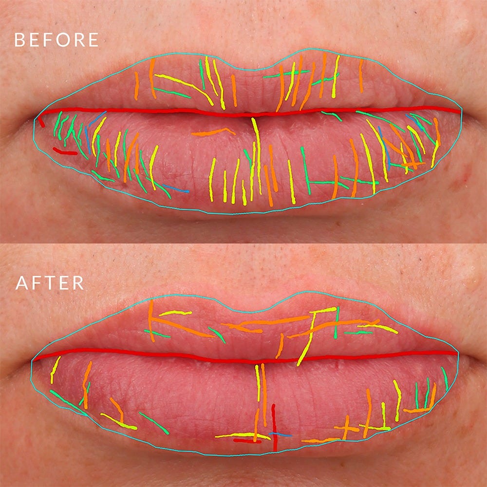 PMD Beauty Kiss Lip Plumping System
