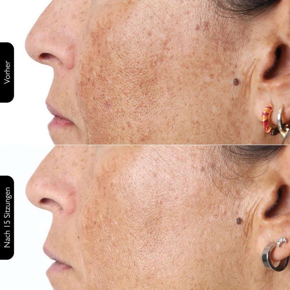 Silk'n FaceTite MultiPlatform + Serum Bundle Maximizer Kit