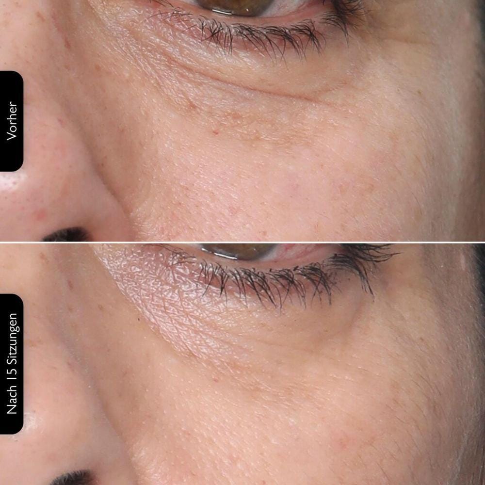 Silk'n FaceTite MultiPlatform + Serum Bundle Maximizer Kit