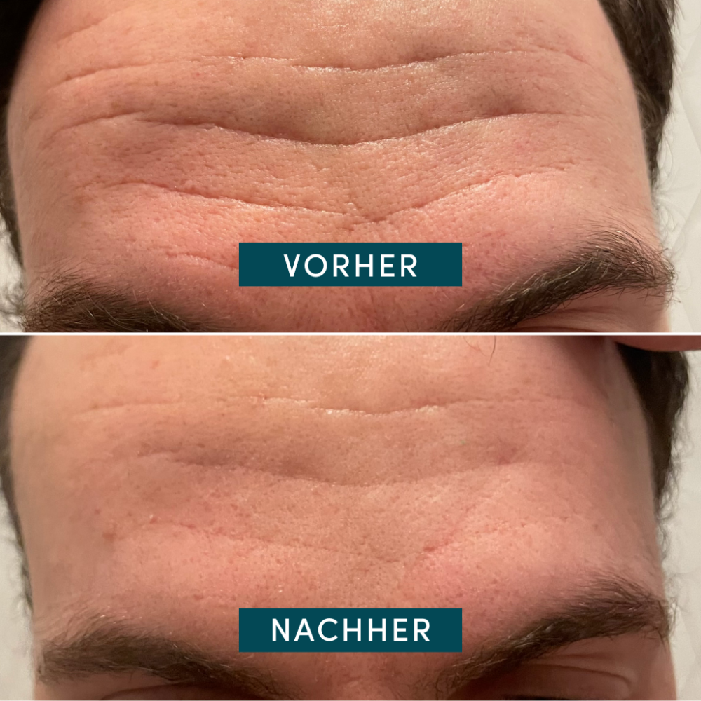 APRICOT Gesicht Patches mit Niacinamid