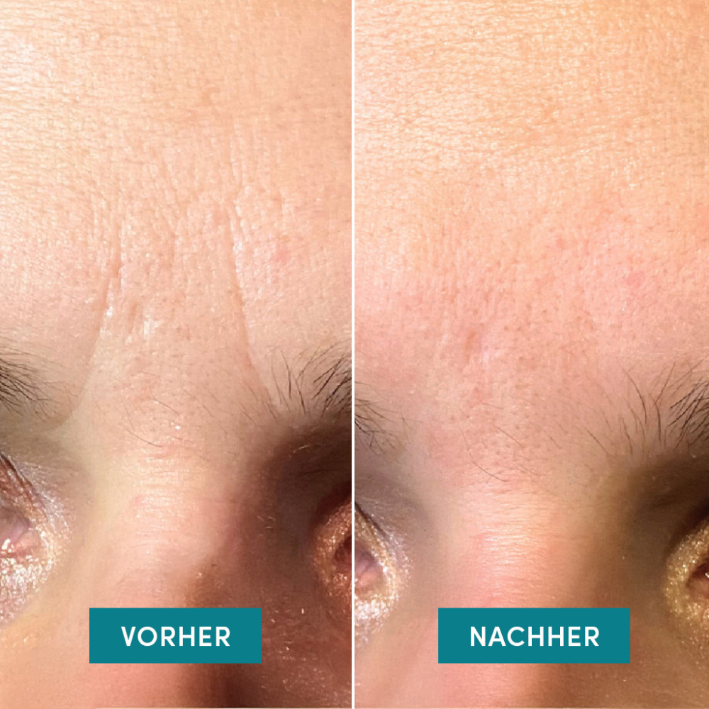APRICOT Gesicht Patches mit Ectoin