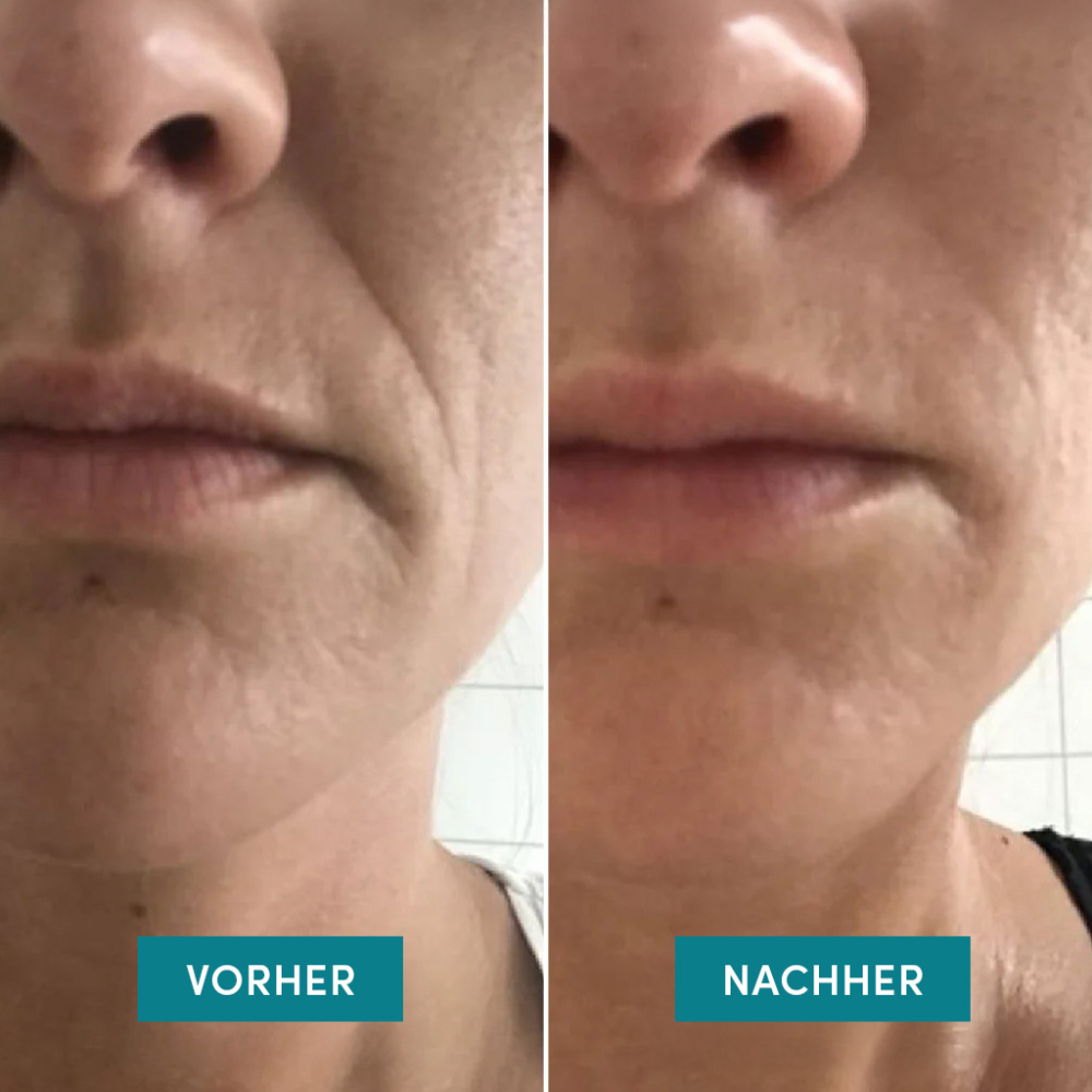 APRICOT Mund Patches mit Ectoin